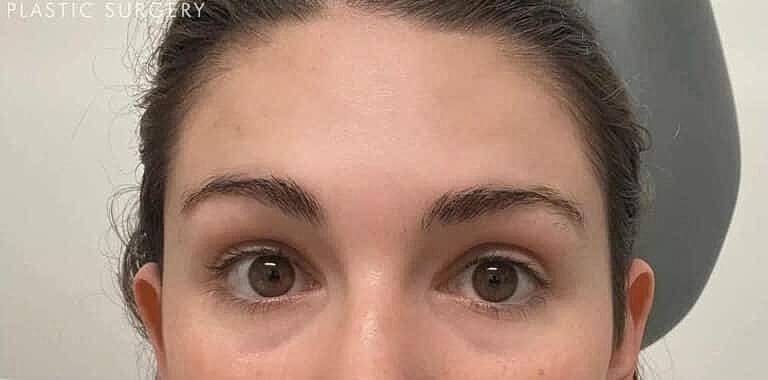 Xeomin Before & After