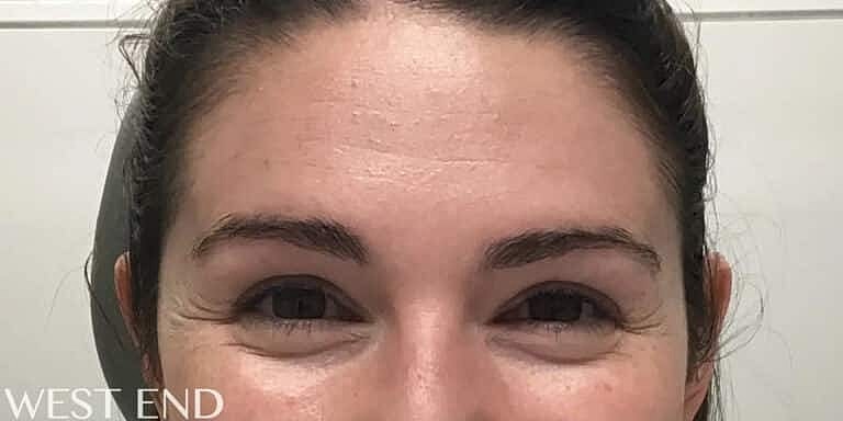 Xeomin Before & After