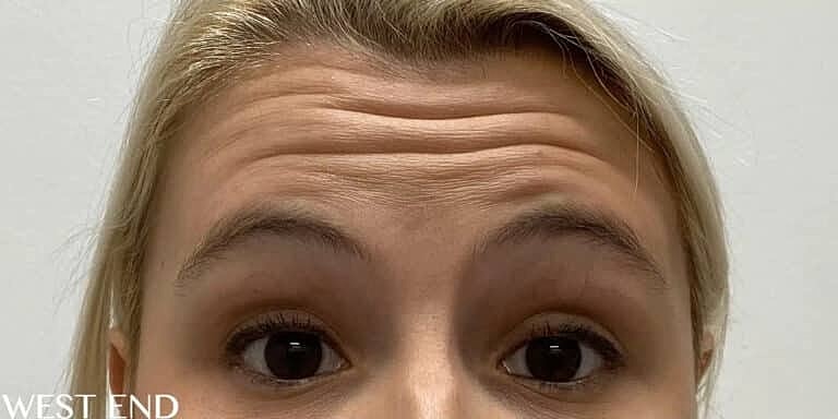 Xeomin Before & After