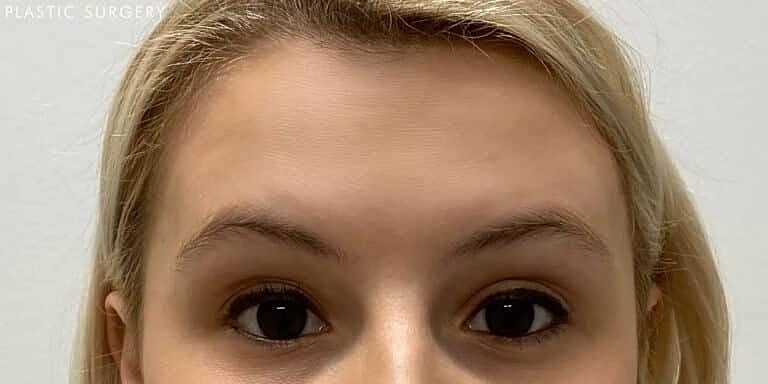 Xeomin Before & After