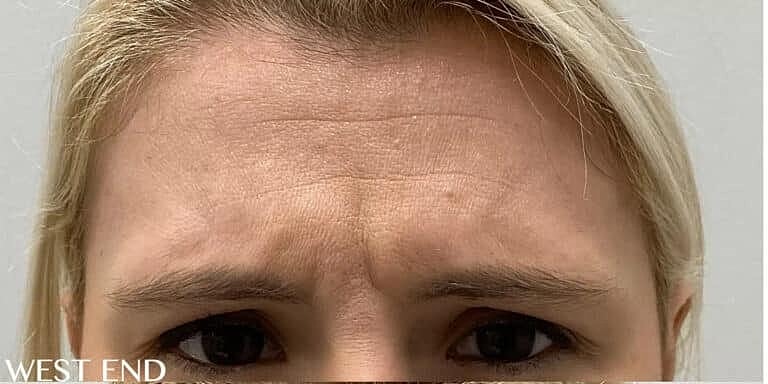 Xeomin Before & After