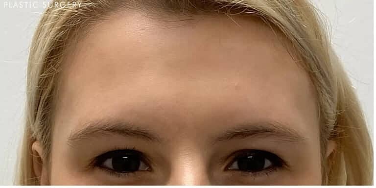 Xeomin Before & After