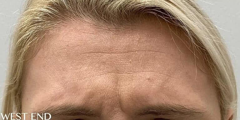 Xeomin Before & After