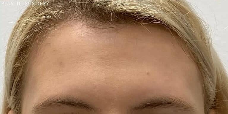 Xeomin Before & After