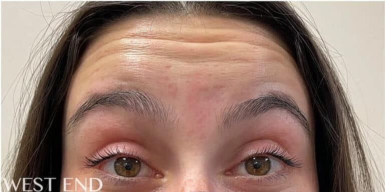Xeomin Before & After