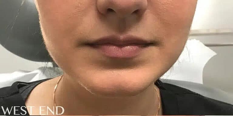 Xeomin Before & After