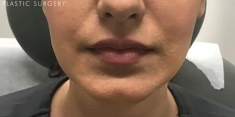 Xeomin Before & After