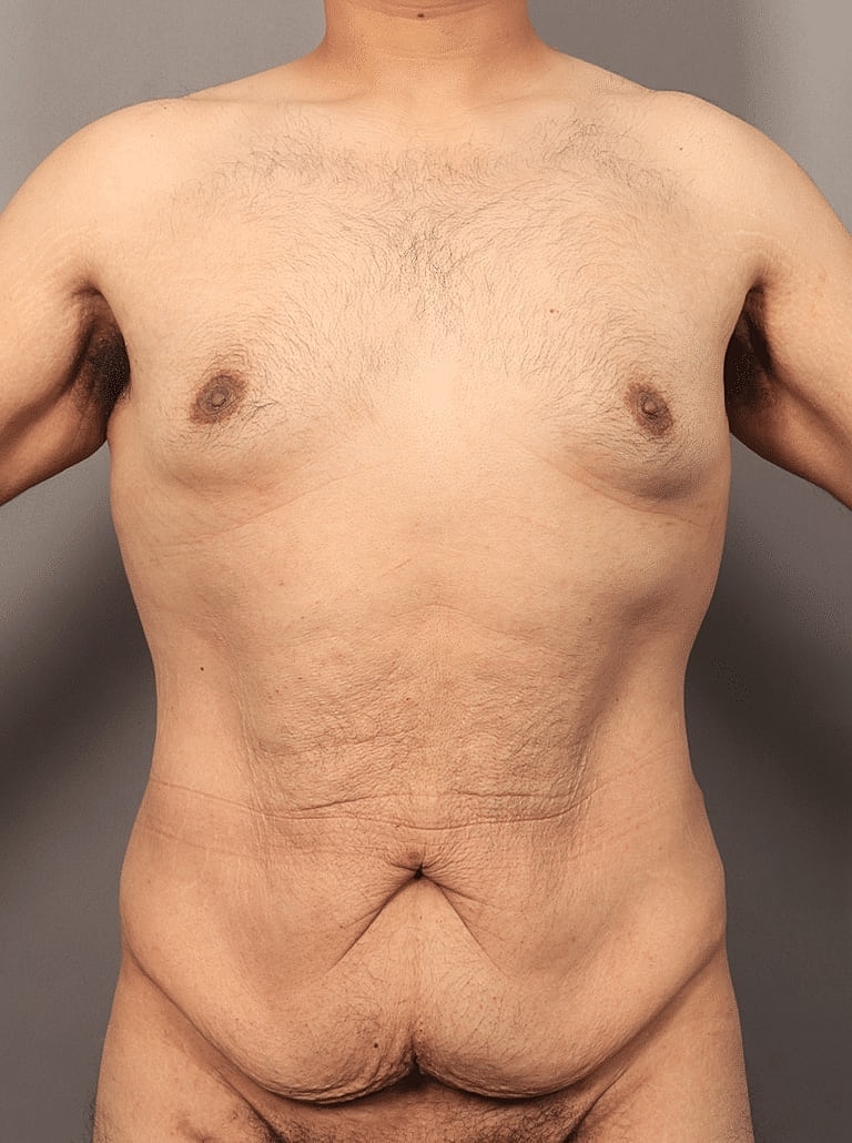 Tummy Tuck Before & After