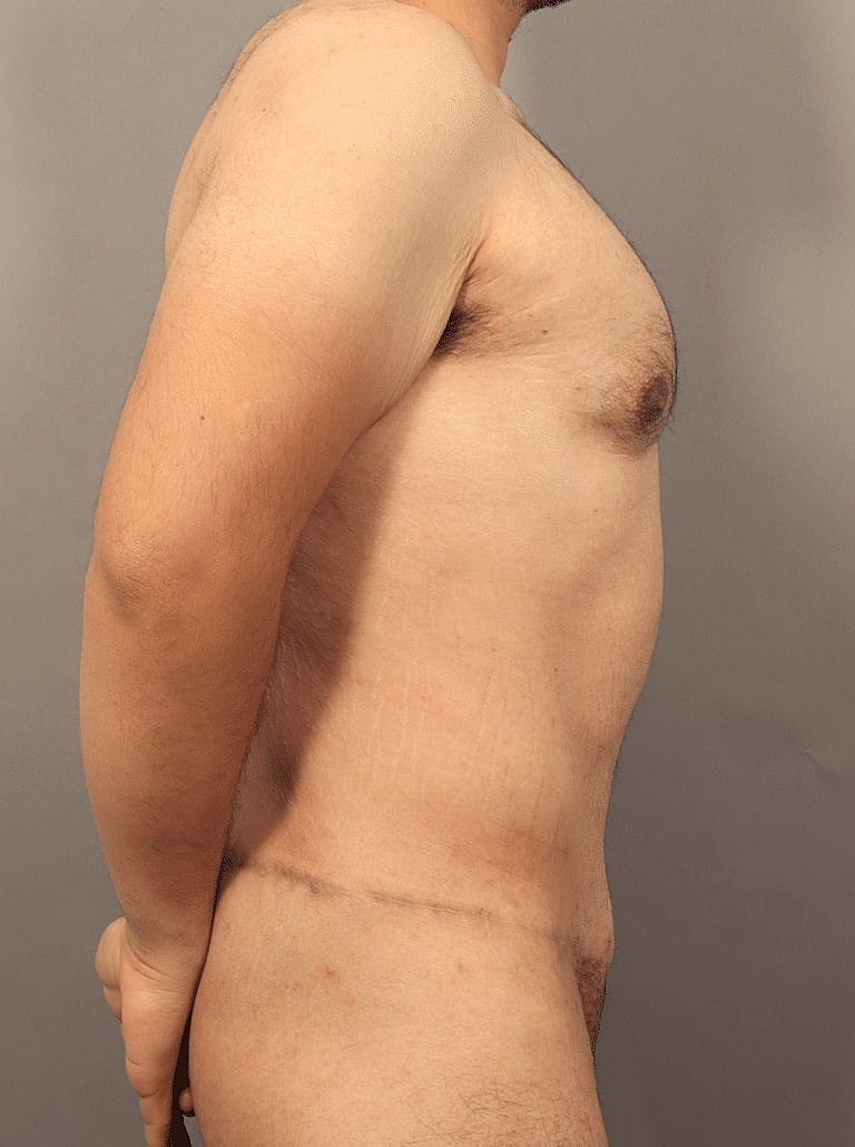 Tummy Tuck Before & After