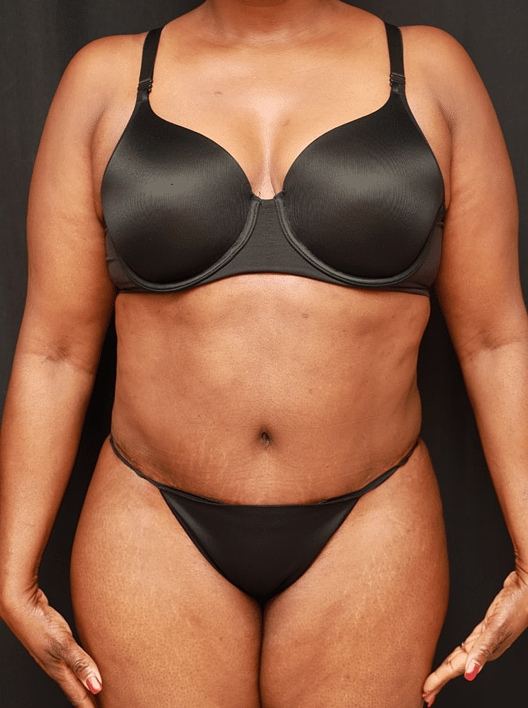 Tummy Tuck Before & After