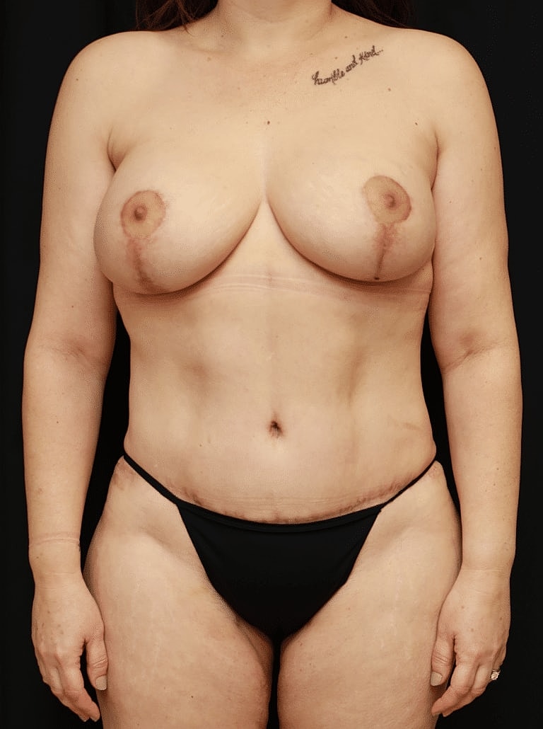 Tummy Tuck Before & After