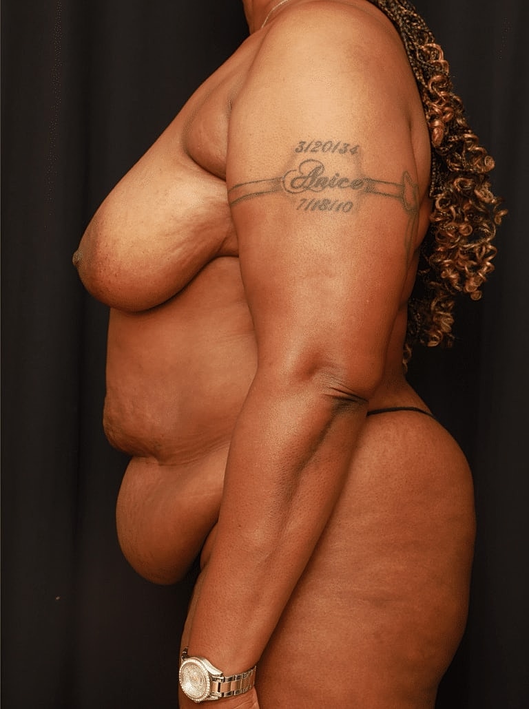 Tummy Tuck Before & After