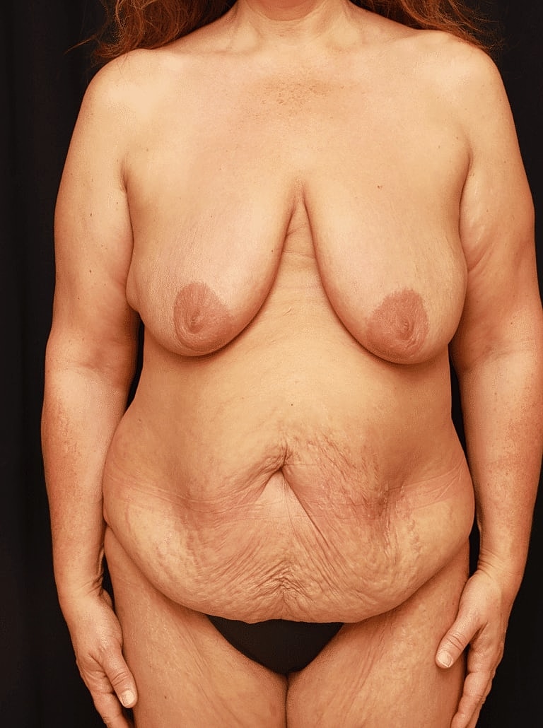 Tummy Tuck Before & After