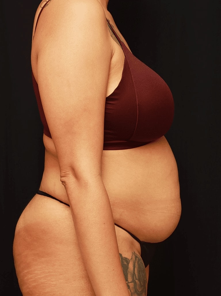 Tummy Tuck Before & After