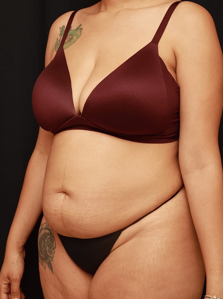 Tummy Tuck Before & After