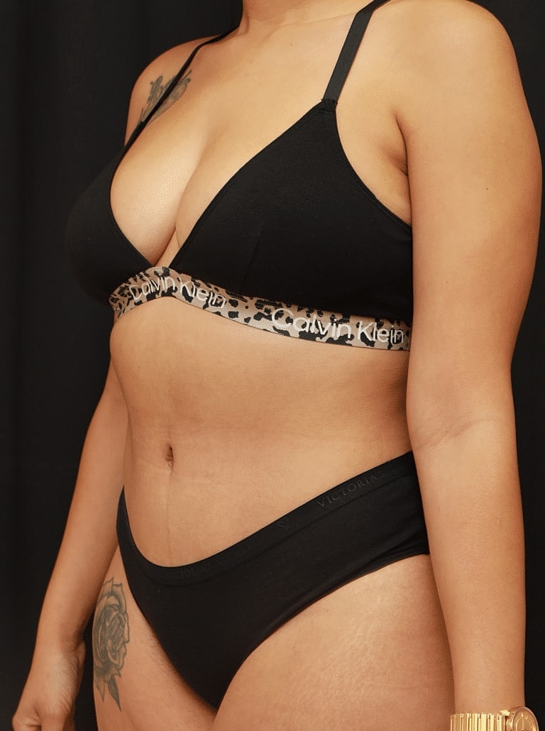 Tummy Tuck Before & After