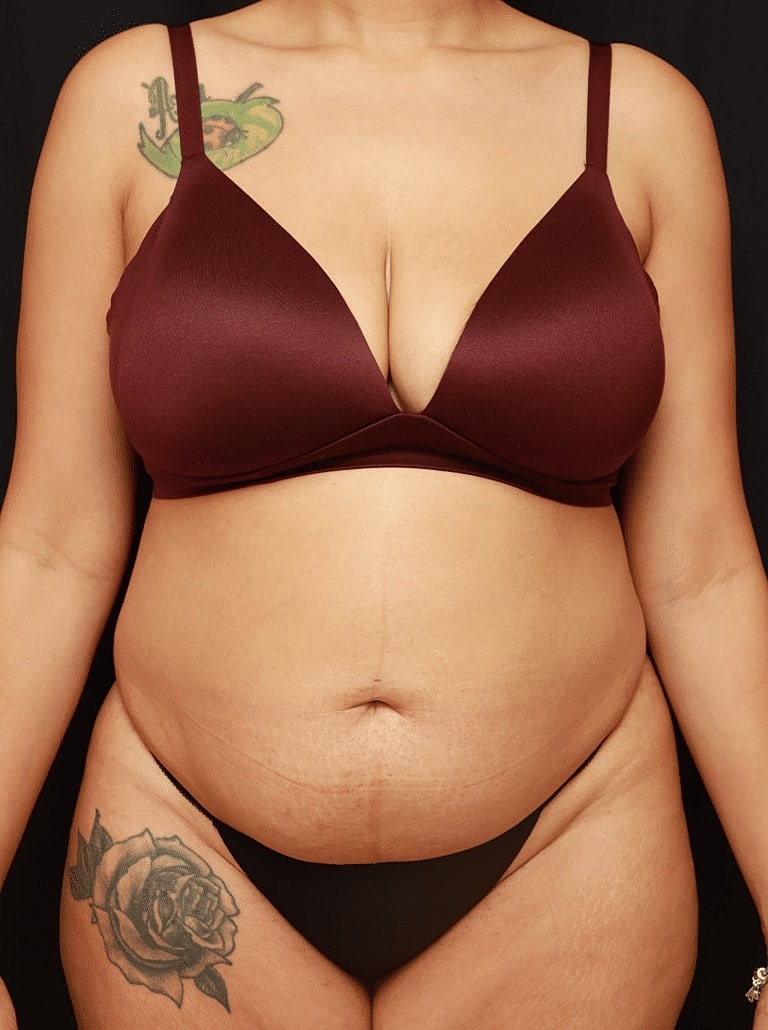 Tummy Tuck Before & After