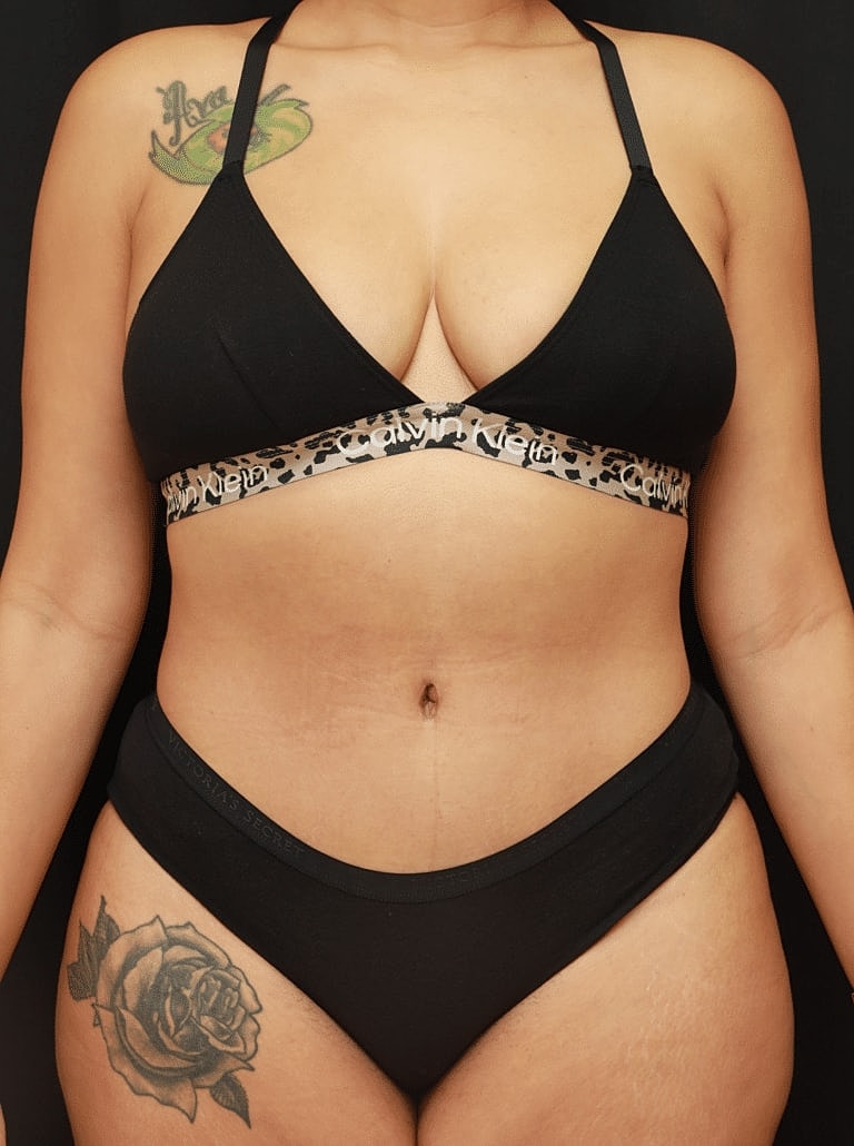 Tummy Tuck Before & After