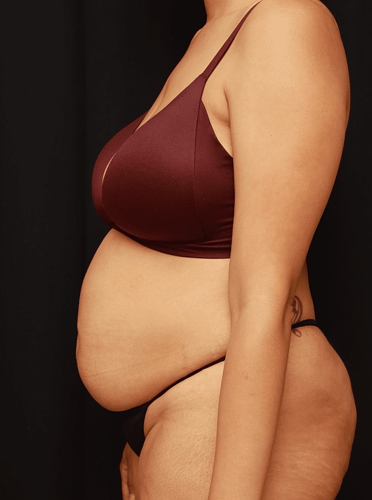 Tummy Tuck Before & After