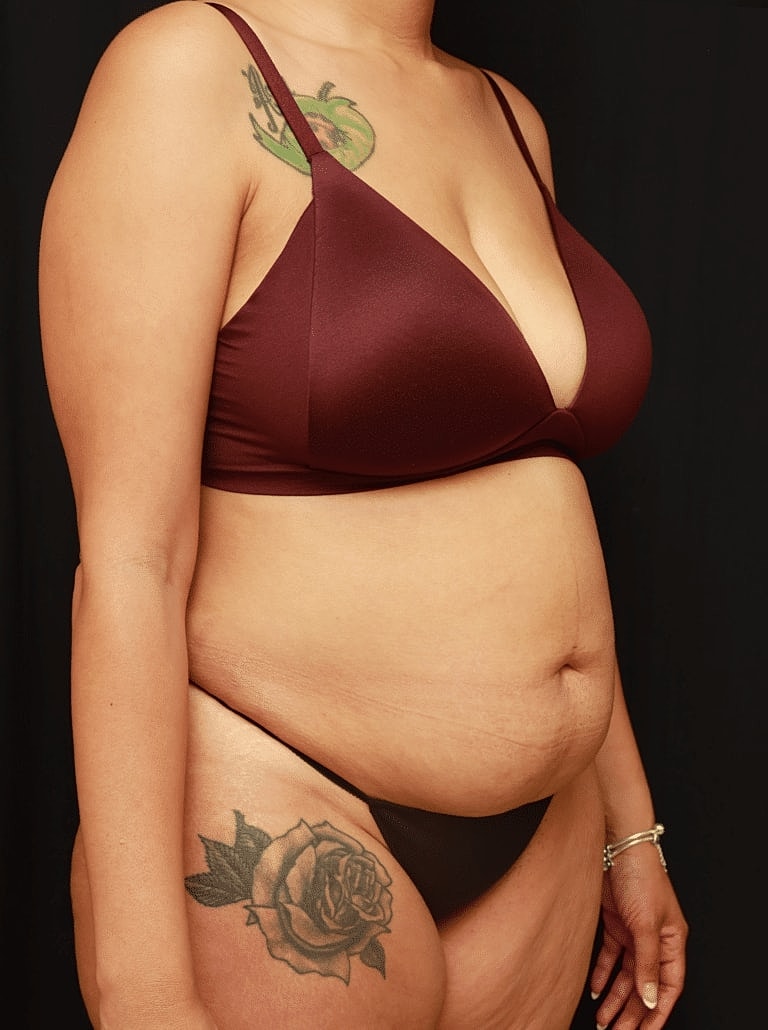 Tummy Tuck Before & After