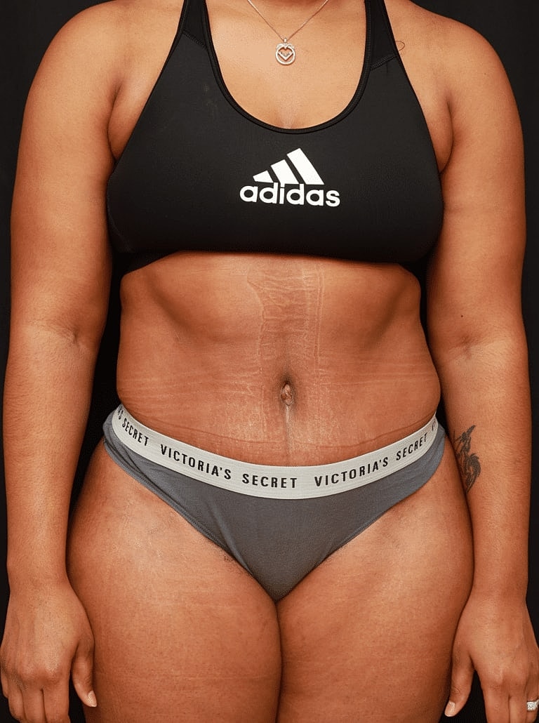 Tummy Tuck Before & After