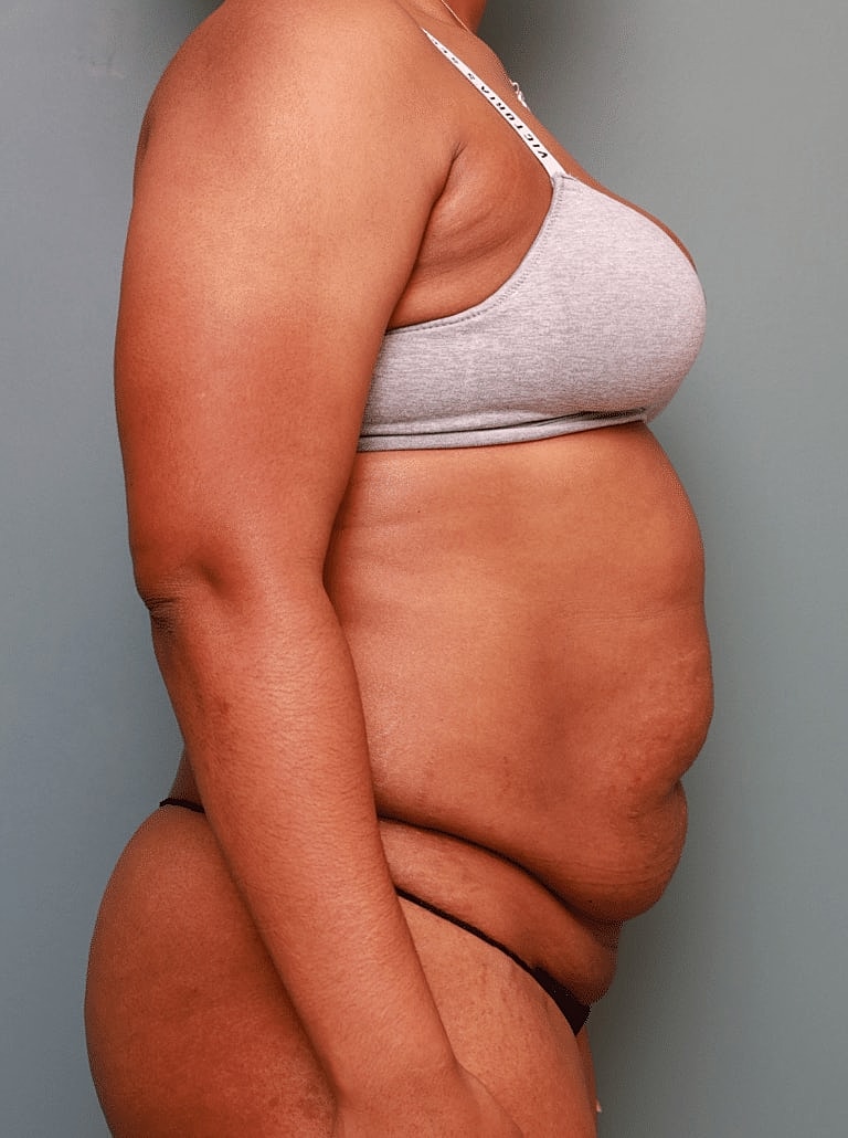 Tummy Tuck Before & After