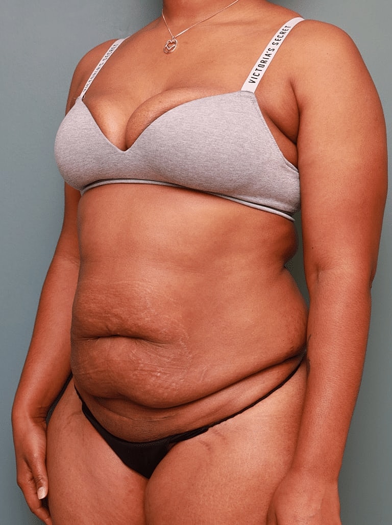 Tummy Tuck Before & After