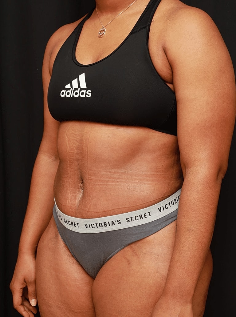 Tummy Tuck Before & After