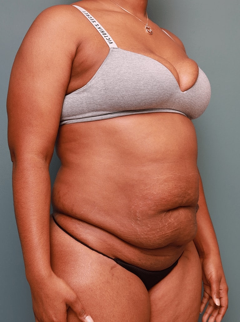 Tummy Tuck Before & After