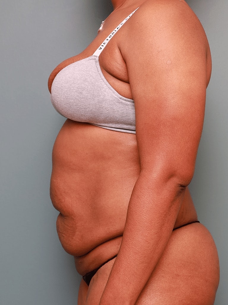 Tummy Tuck Before & After