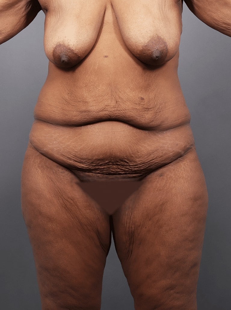 Tummy Tuck Before & After