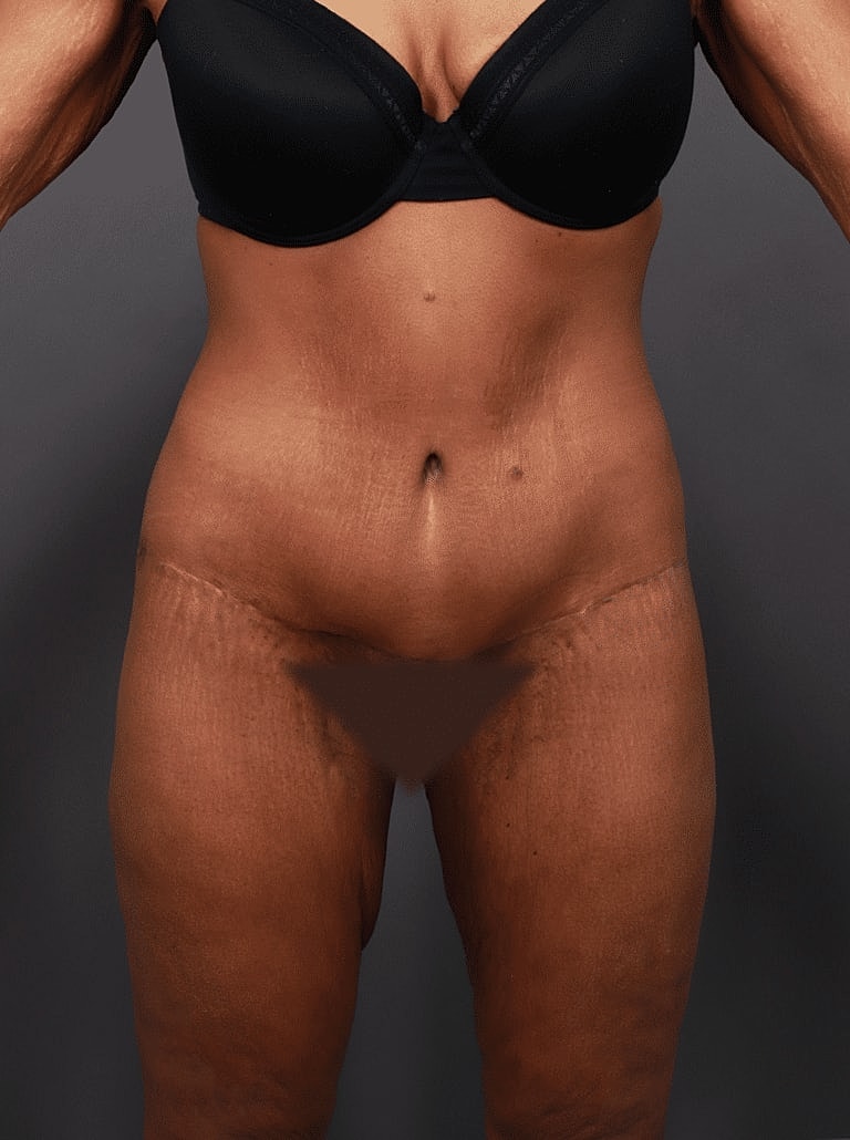 Tummy Tuck Before & After