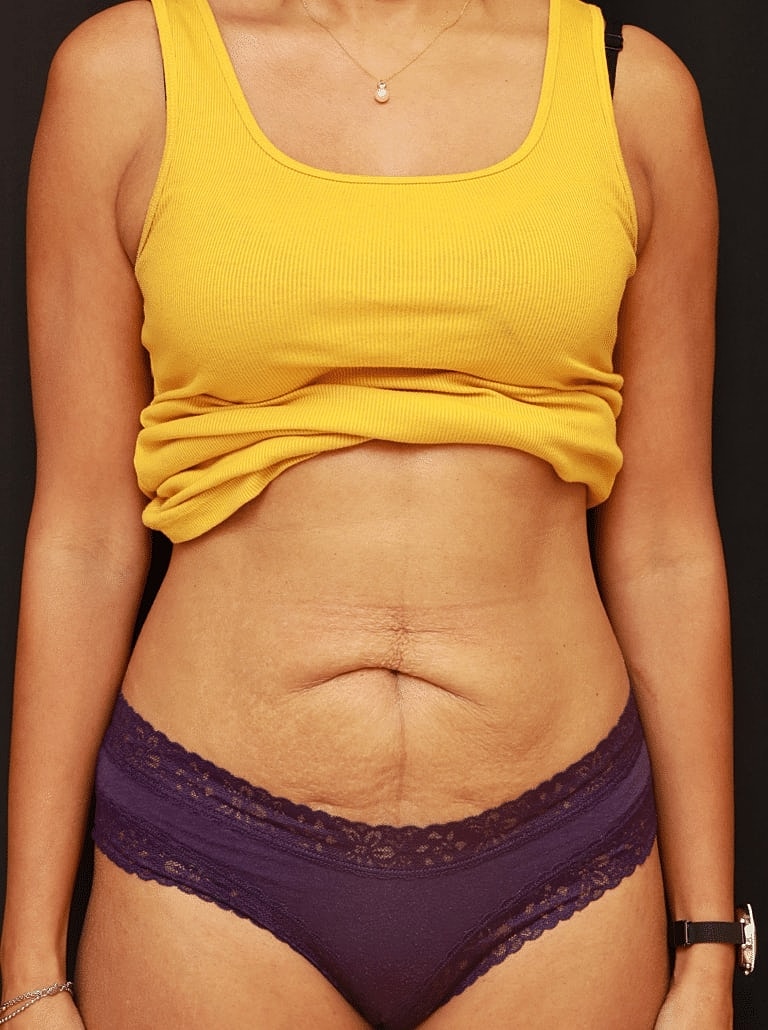 Tummy Tuck Before & After