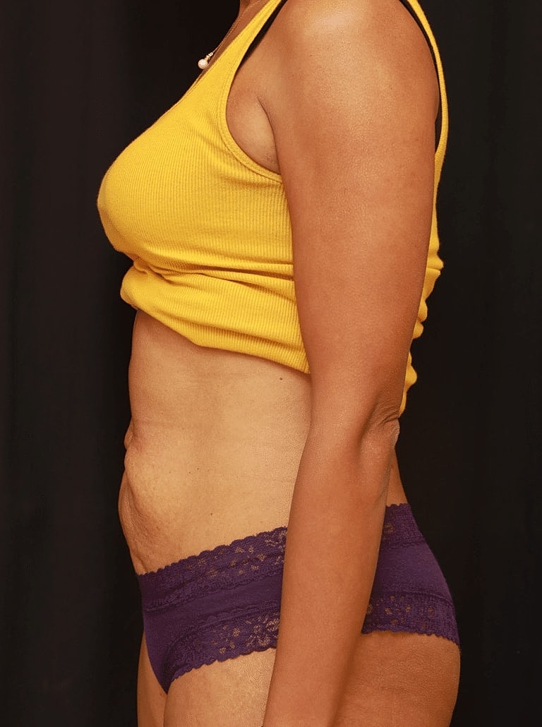 Tummy Tuck Before & After