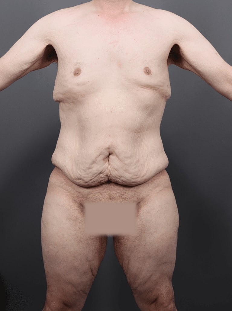 Tummy Tuck Before & After