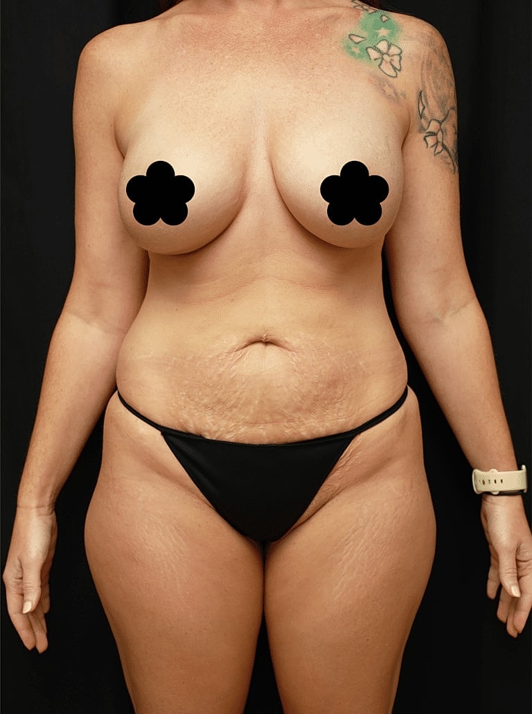 Tummy Tuck Before & After