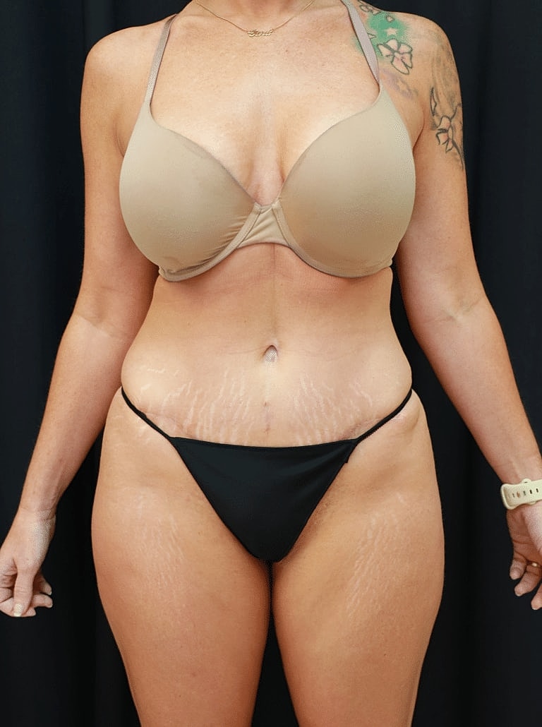 Tummy Tuck Before & After