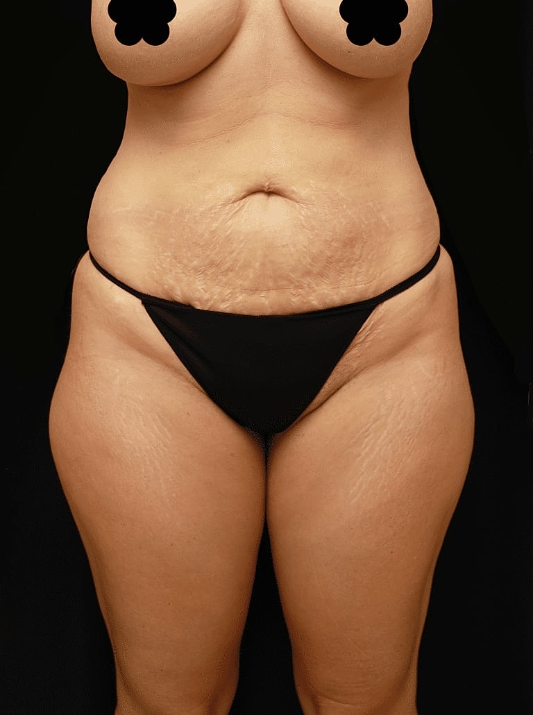 Tummy Tuck Before & After
