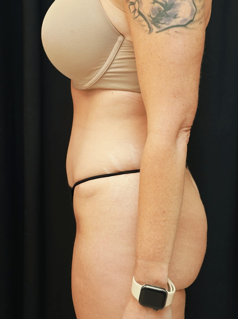 Tummy Tuck Before & After