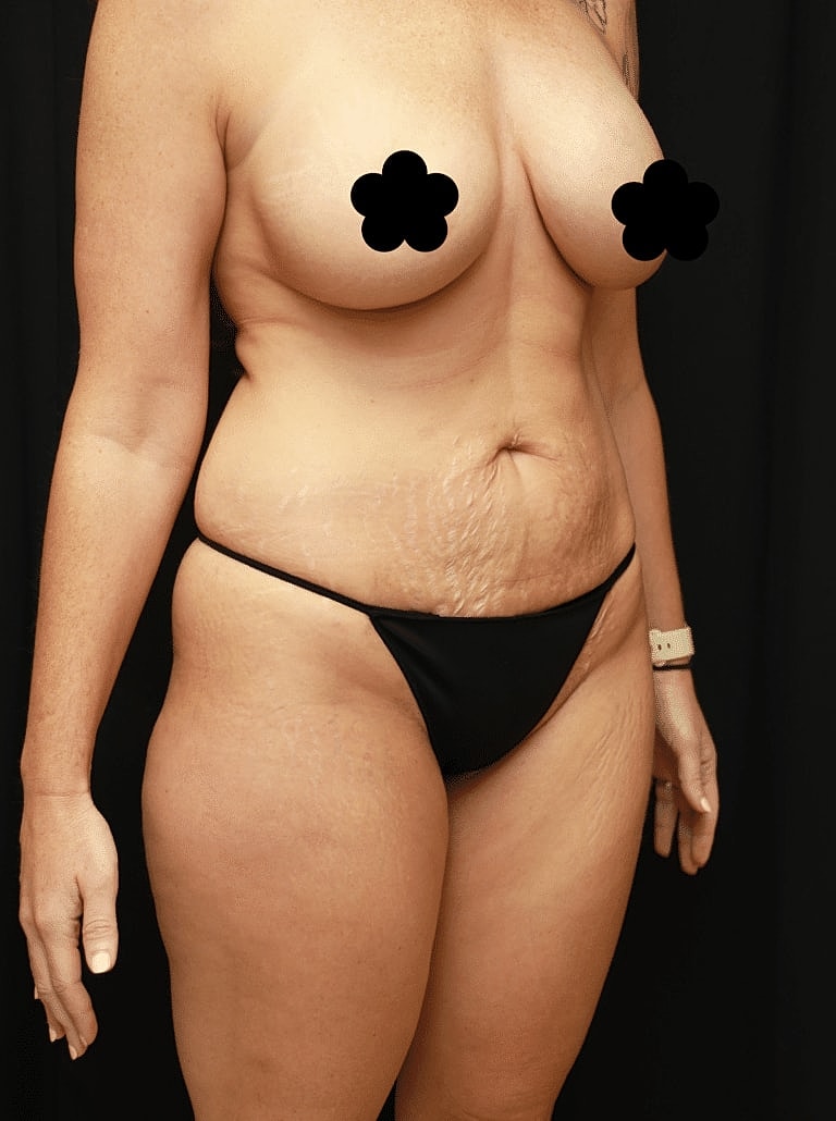 Tummy Tuck Before & After