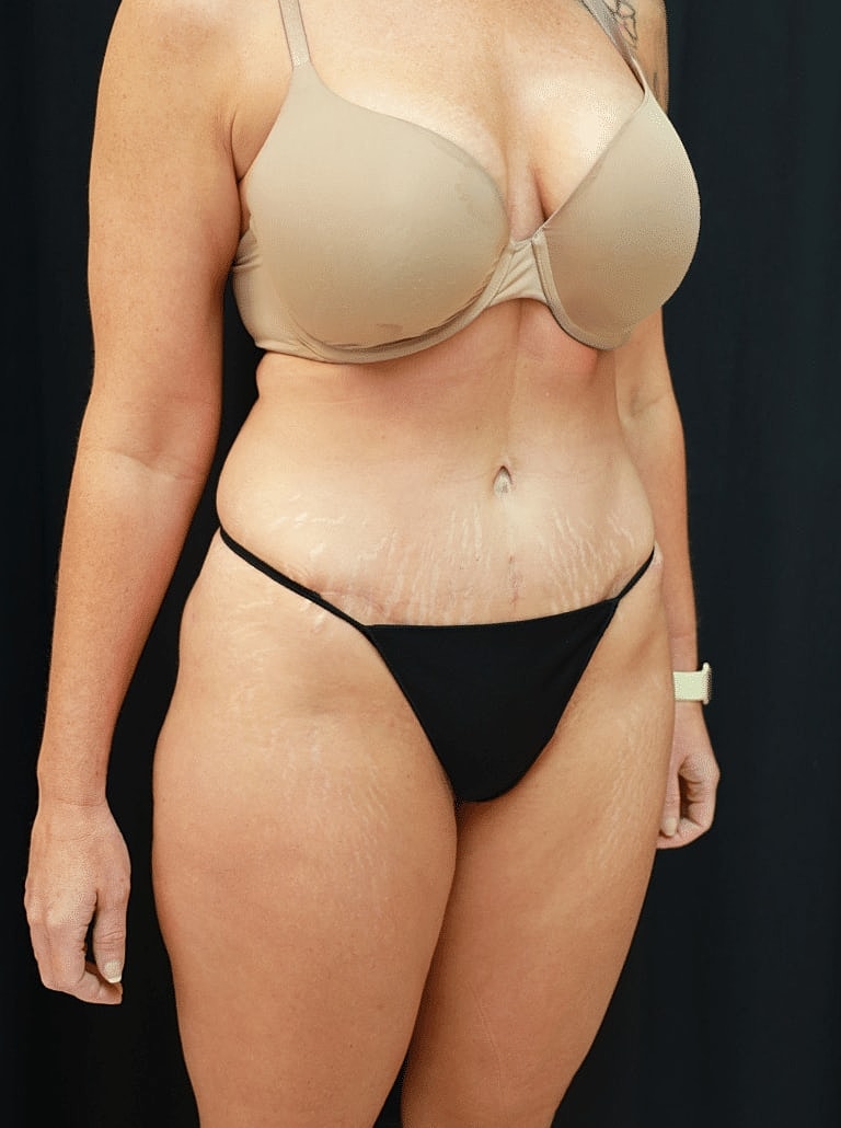 Tummy Tuck Before & After