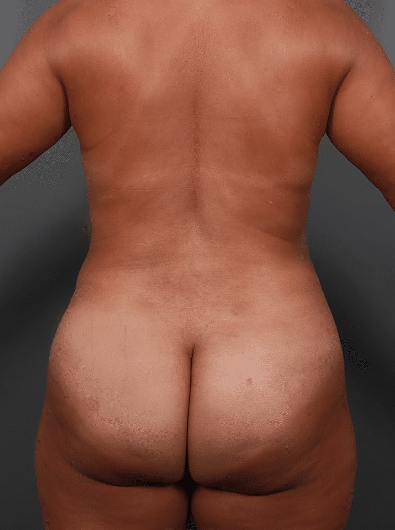 Tummy Tuck Before & After