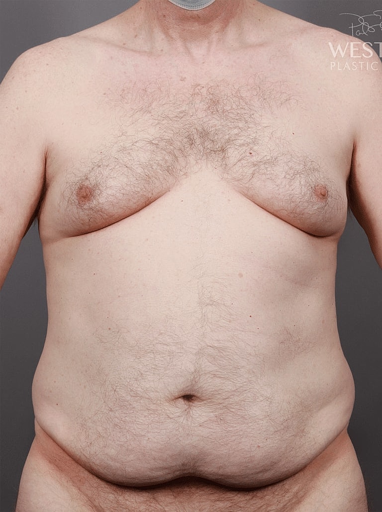 Tummy Tuck Before & After