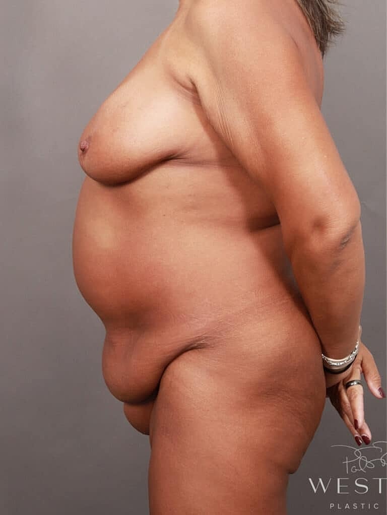 Tummy Tuck Before & After