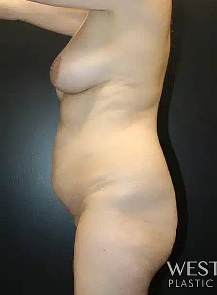 Tummy Tuck Before & After