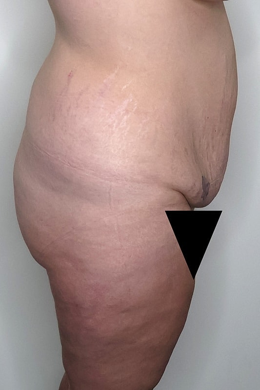 Tummy Tuck Before & After