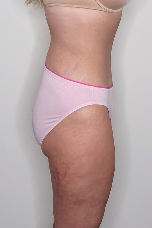 Tummy Tuck Before & After