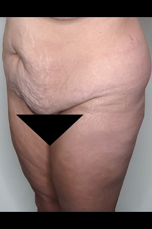 Tummy Tuck Before & After