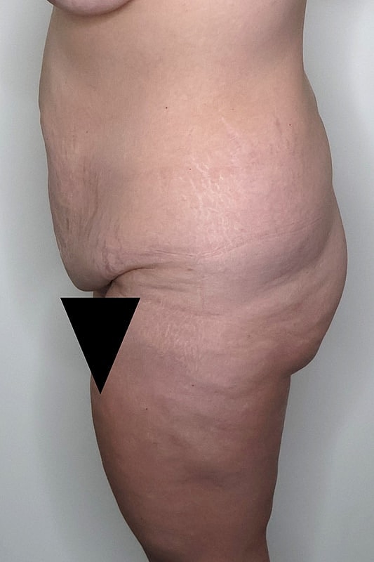 Tummy Tuck Before & After