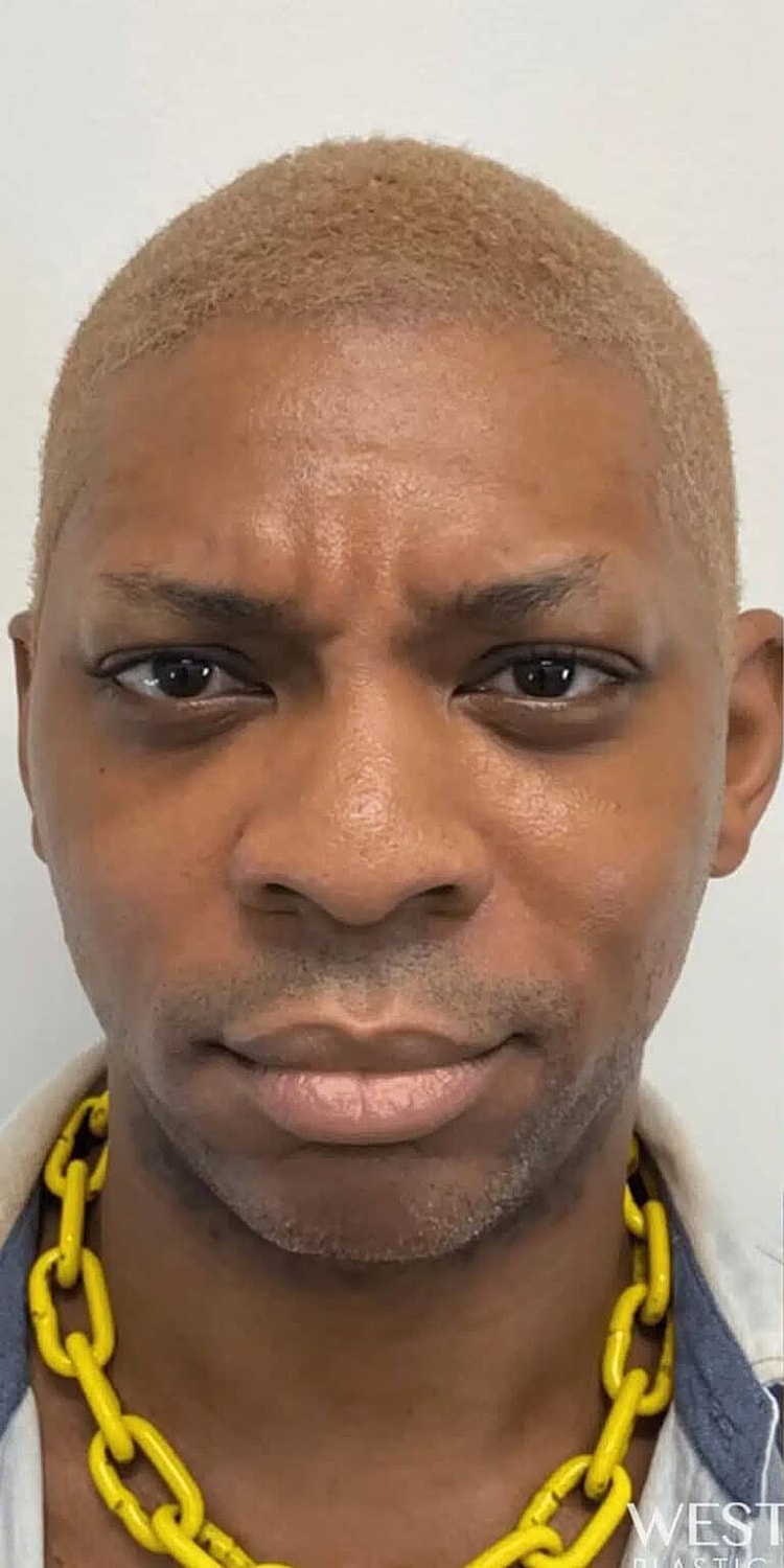 Dysport Before & After